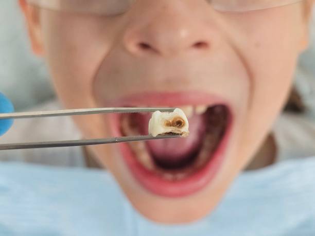 Best Knocked-Out Tooth (Avulsed Tooth) Treatment in Rkville, PA